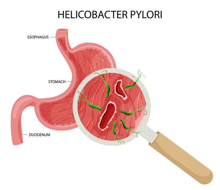 Image showing Helicobacter Pylori causing Peptic ulcers